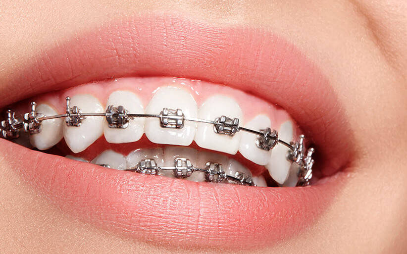 sonrisa brackets metalicos